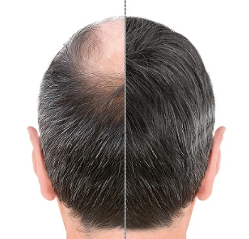 Hair Transplant