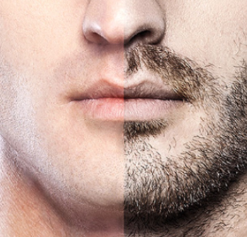 Beard Transplant